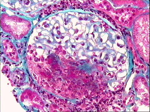 glomerular Basement membrane SLE Chronic Infection (Endocarditis, HCV,