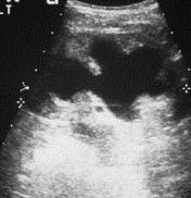 Renal ultrasound Normal