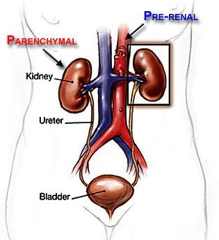 Evaluation of Acute Kidney Injury (AKI) What caused it?