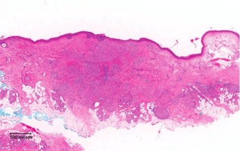 Annular elastolytic giant cell granuloma 153 Topical fluticasone propionate cream was prescribed. The lesions remained static with no clinical deterioration.