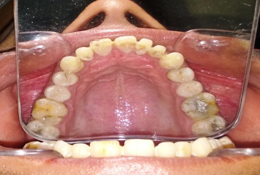 A three tier diamond depth cutter was used for labial reduction to a depth of 0.5 mm.