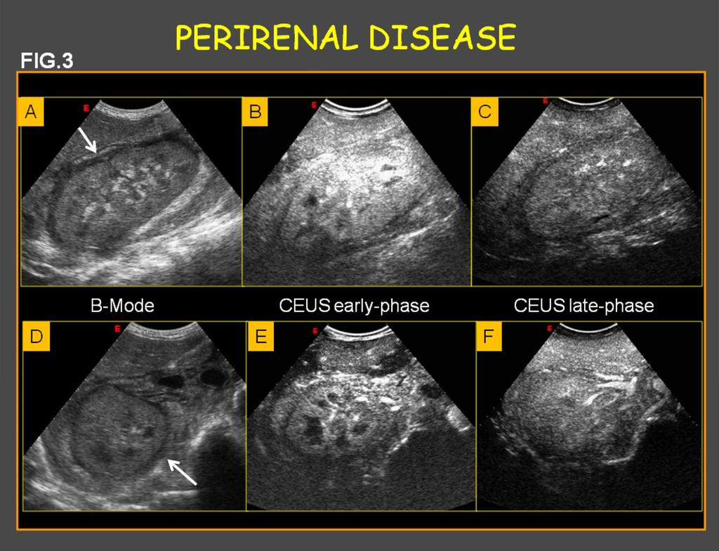 Fig. 3: Fig.3: PERIRENAL DISEASE. Imaging with US and CEUS of perirenal lymphoma. (A),(D) Longitudinal and transverse baseline sonograms show a subtle inhomogeneous hypoechoic soft tissue (arrows).