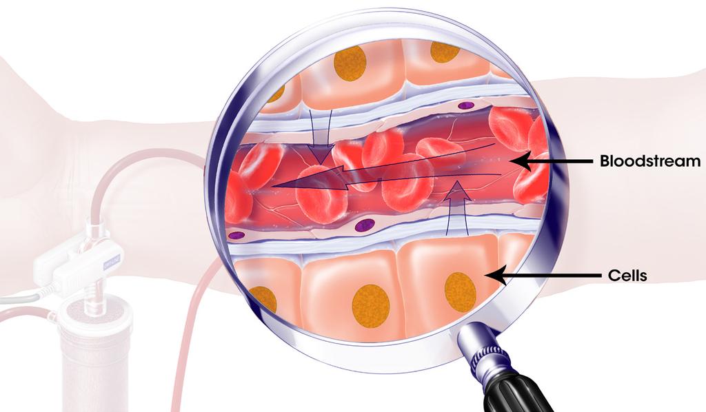 A View Inside Your Bloodstream Does Dialysis Help Remove This Extra Fluid?