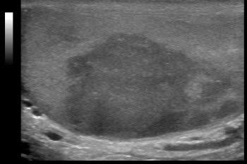 965 mci of FDG demonstrating isolated relapse within the right testicle with SUVmax now of 12.4.