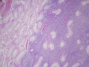 B-cell non-hodgkin's lymphoma. Right testicular pathologic specimen.