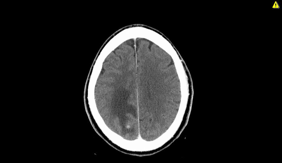 Cerebral metastasis or primary