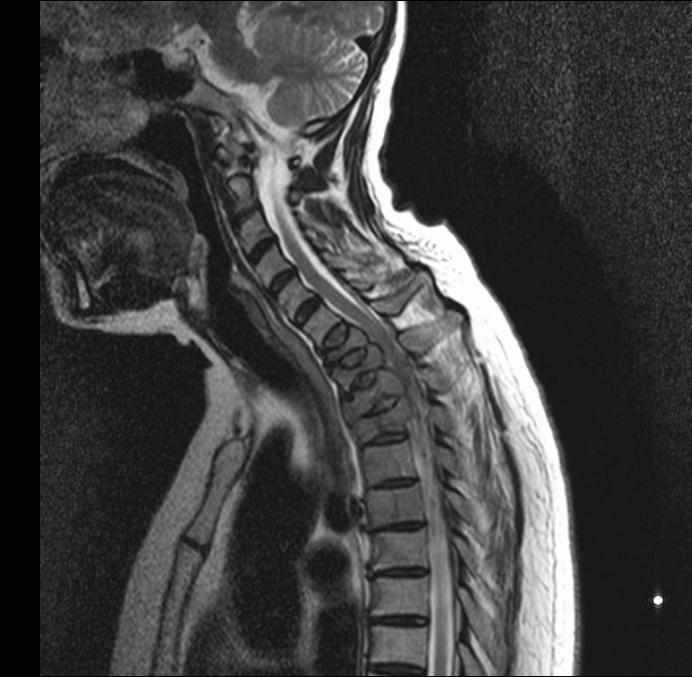 Metastatic Spinal cord compression 59yrs female Short history of weakness & loss of sensation right hand with pain in neck Contacted directly by MRI 26