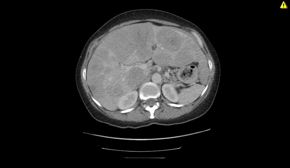 Liver metastases only How do we manage this case?