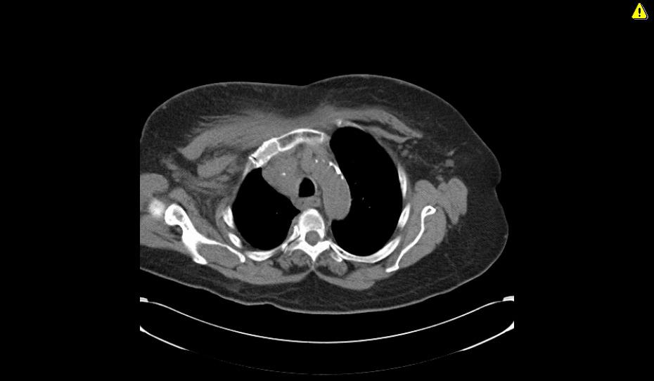 Superior venal caval obstruction 80 yrs Increasing SOB CT shows SVCO What about a diagnosis?