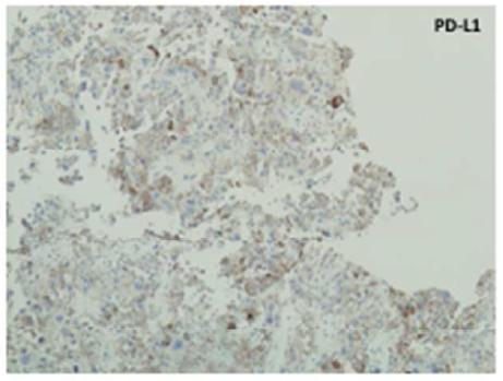 PD- L1 & PD- L2 expression in NSCLC in PLWH 24