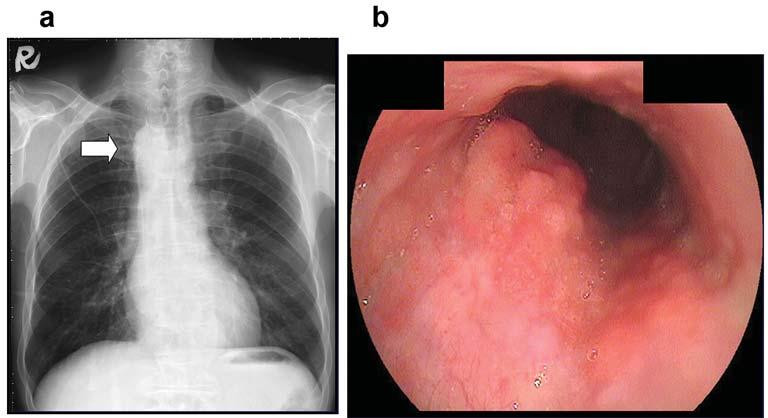 Figure 1. a: Chest X-ray radiograph. b: Esophagoscopy. The chest X-ray showed the right aortic arch (white arrow).