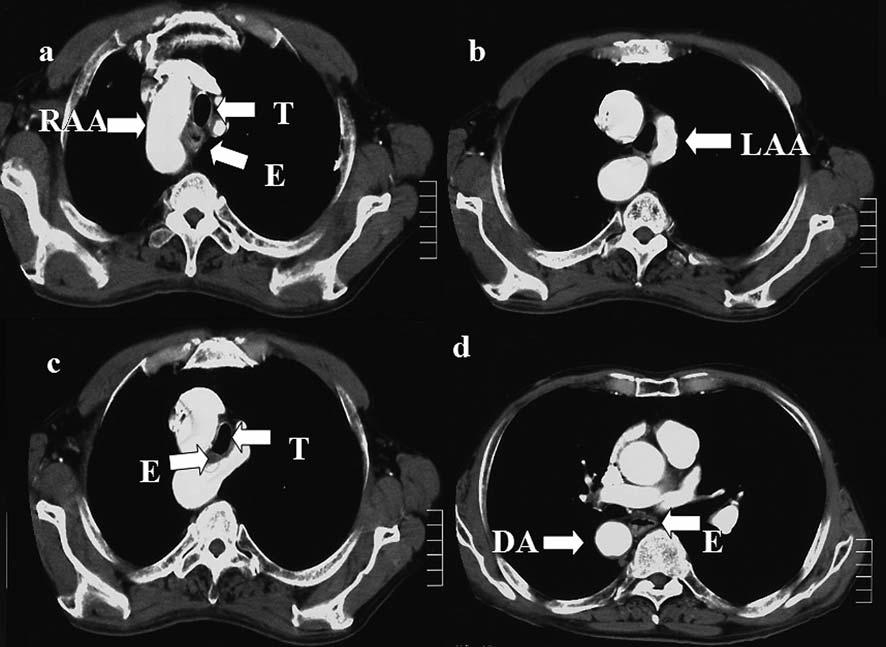 Kubo et al: Successful Resection of Esophageal Carcinoma with DAA Figure 3. Contrasting chest computed tomography (CT). The CT image shows the right and left aortic arch.