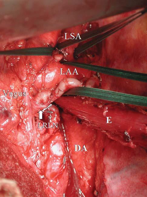 Figure 5. Intraoperative view at the upper mediastinum through the left thoracotomy. The left recurrent laryngeal nerve passed behind the left aortic arch and ascended posteriorly.