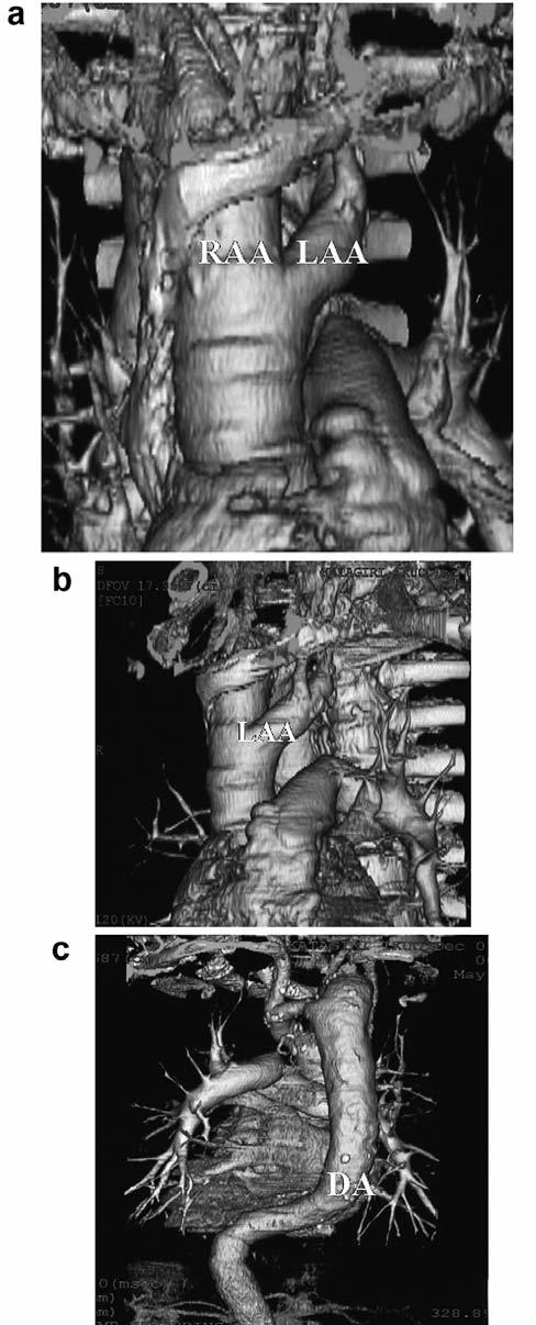 Three-dimensional construction images of CT (3D-CT): the frontal view (a), the left lateral view (b), the back view (c).
