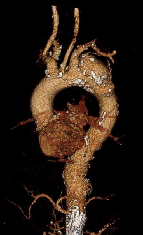 Bolton RelayBranch Device Patient #1: Aortic arch aneurysm, poor surgical candidate 57 y.o. male with 64 mm aneurysm PMH/PSH: EVAR,