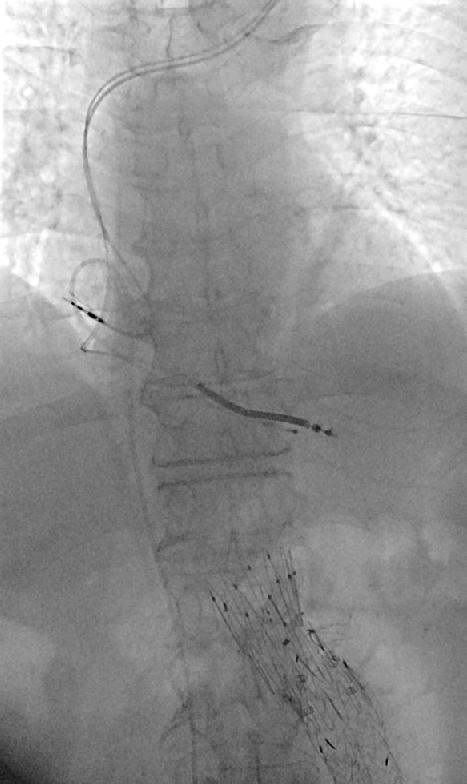 Bolton RelayBranch Device Patient #1: Underwent repair on 1/8/18 Left carotid subclavian bypass Open
