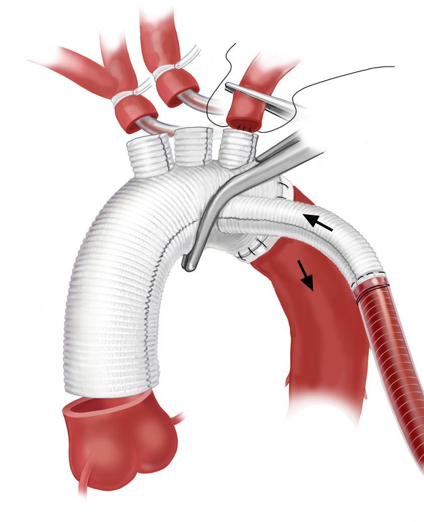 Open Total Arch Repair Technically demanding Complex circulatory management