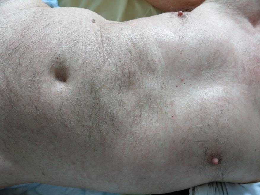 Severe cutaneous adverse reaction associated with vemurafenib: DRESS, AGEP or
