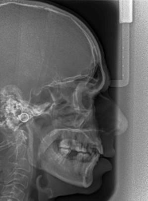 Figure - 6: Crooked appearance. Results The present study analyzed a total of 150 digital lateral cephalograms.