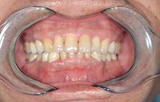 After laser irradiation, slight whitening and vaporization of the surface gingival tissue were observed (Fig 6).