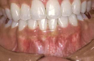 the gingival tissue was observed after two