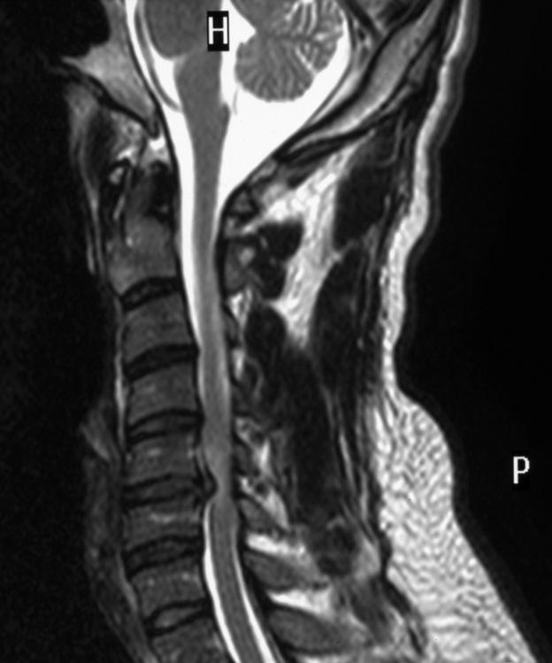 Following your recent MRI scan and consultation with your spinal surgeon, you have been diagnosed with having a cervical disc protrusion resulting in nerve root compression (trapped nerve) and arm