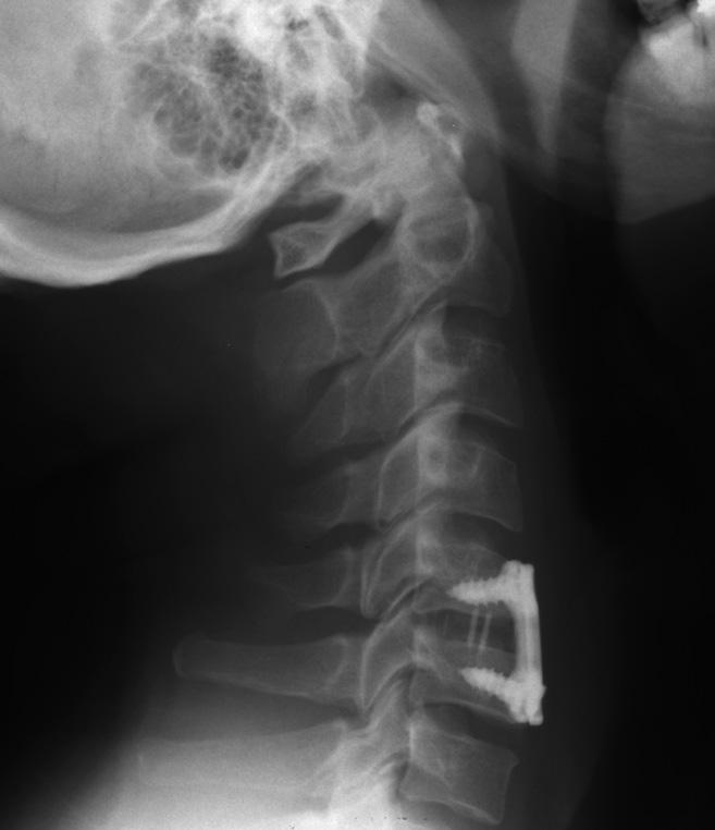 X-ray showing the bone graft and plate in position 2 Cervical vertebrae Skull 3 4 Plate over the front of C5 / 6 cage and bone graft 7 7 Risks and complications As with any form of surgery, there are