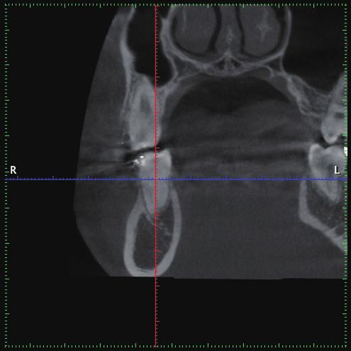 3: Measurements were performed on slices in the frontal plane inferior to the blue line. operative position of a TAD in the area studied, the axial (Fig. 2) and frontal (Fig.