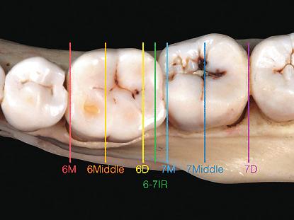3D Cortical Bone Anatomy of the Mandibular Buccal Shelf IJOI 41 The angle (green double-headed arrow) measured was formed by the cortical outline of the MBS (green lines) relative to the axial