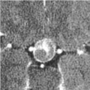 Suprasellar: Aneurysm CT Noncalcified central suprasellar