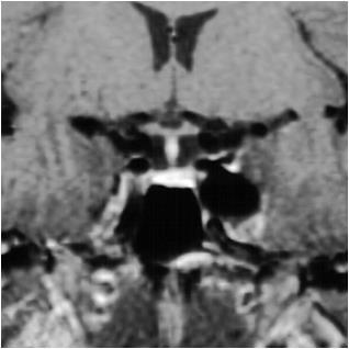 Parasellar: Aneurysm MRI Flow void or