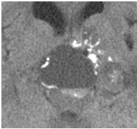 Craniopharyngioma: CT NECT scan