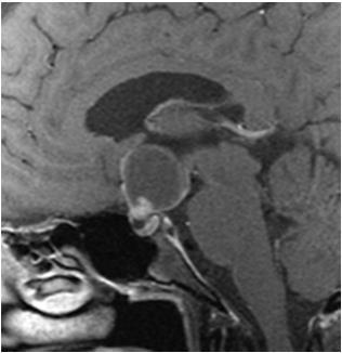 Craniopharyngioma: MR Variable signal Often heterogeneous Ca++ difficult to detect