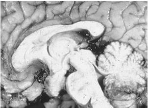 Chiasmatic-hypothalamic glioma Pathology 30% of all pilocytic astrocytomas occur in chiasm or