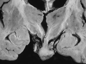 Hypothalamic Hamartoma Pathology Hamartoma of tuber cinereum
