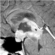 Germinoma: Imaging CT & MR Combined lesion typical but may affect only infundibular stalk May be