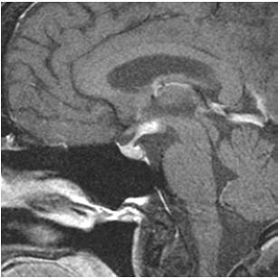 Imaging Pituitary gland, hypothalamus, stalk Hyperdense on CT T1