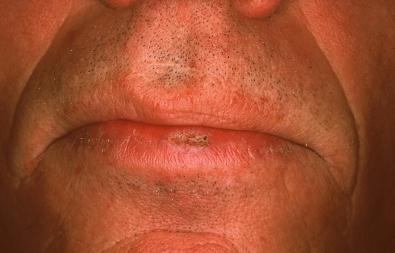 Premalignant skin tumours page: 437 Actinic cheilitis Relatively well-demarcated scaly erythematous plaque, sometimes encrusted and occurring essentially on the lower lip.
