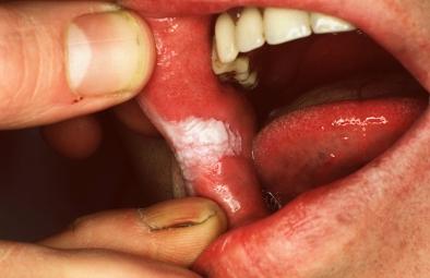 Premalignant skin tumours page: 438 Leucoplakia smoker's keratosis (stomatitis nicotina) Well-demarcated and more or less rounded white or greyish plaques on the lower lip or the buccal