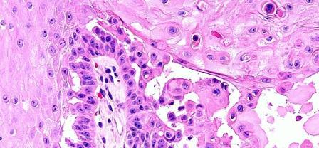keratincytes near the basal layer due to