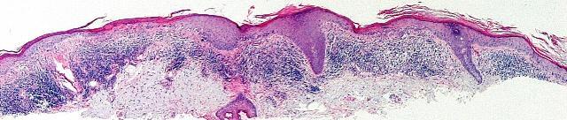 Actinic keratosis, lichenoid type In addition to