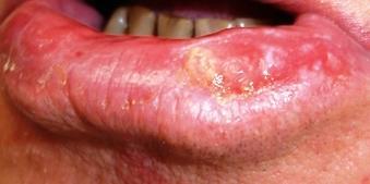 Actinic cheilitis and Cutaneous horn This is actinic keratosis