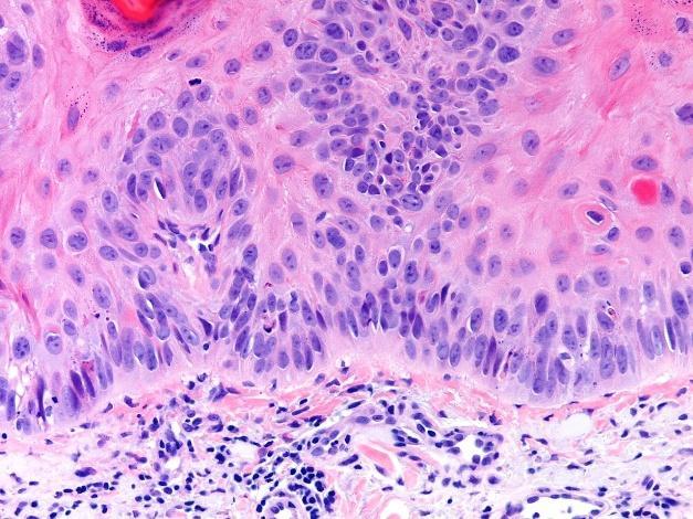Dysplastic squamous cells making abnormal compact keratin on top.