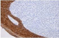 Malignant melanoma of nodular type. There are two separate tumours.