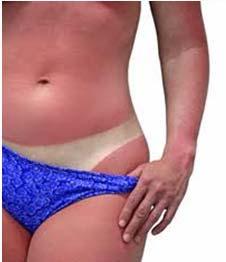 Intermittent exposure to ultraviolet radiation (UVR) during childhood. Types I and II skin. Genetic predisposition. Compromised immunity. Proximity to equator.