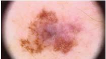 Variable clinical features. Half of melanomas are detected by the patient.