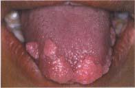 Focal epithelial hyperplasia Virus induced localized proliferation of oral sq epi ( HPV 13 & 32 ) C/F: Childhood condition