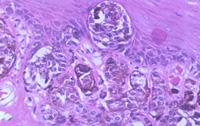 nevus cells