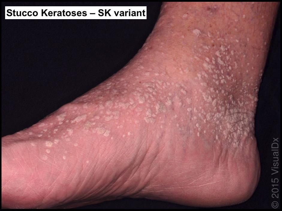 Stucco keratoses papular warty white-gray SKs that commonly occur on the lower legs