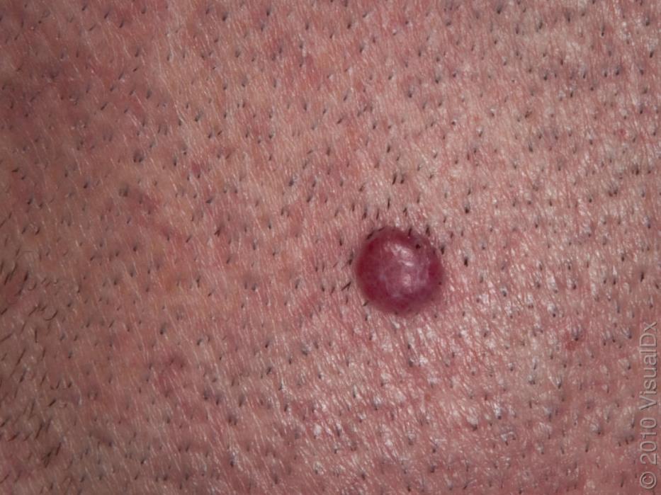 What is the diagnosis? A. Basal Cell Carcinoma B.